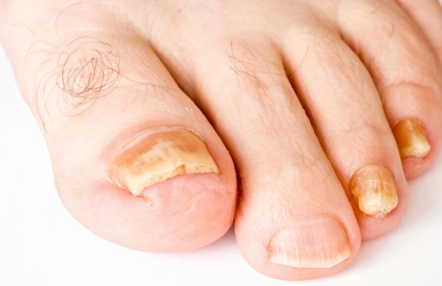 symptoms of fungus on the feet