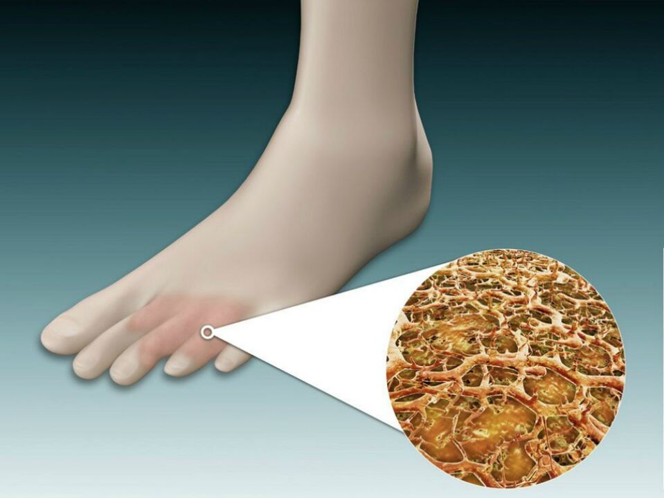 Fungal infection of the feet