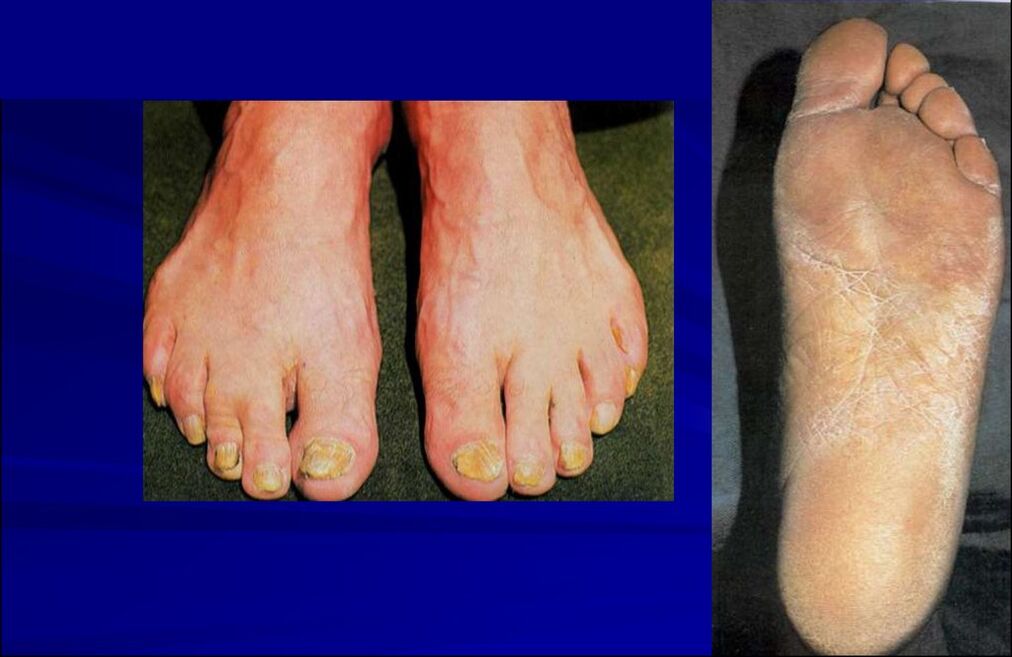 Squamous-hyperkeratotic form of fungus (rubromycosis of the feet)