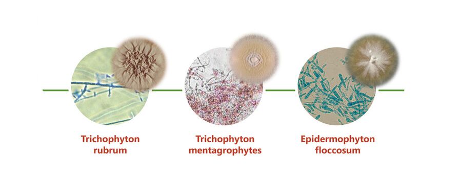 The main causes of skin fungus on the feet