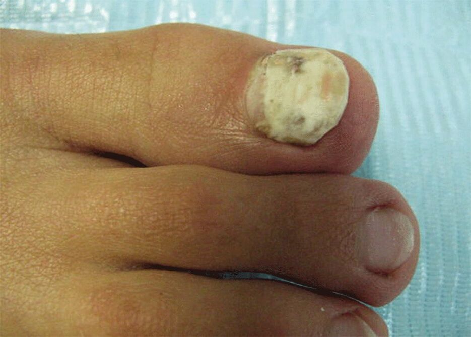 damage to the nail plate with fungus