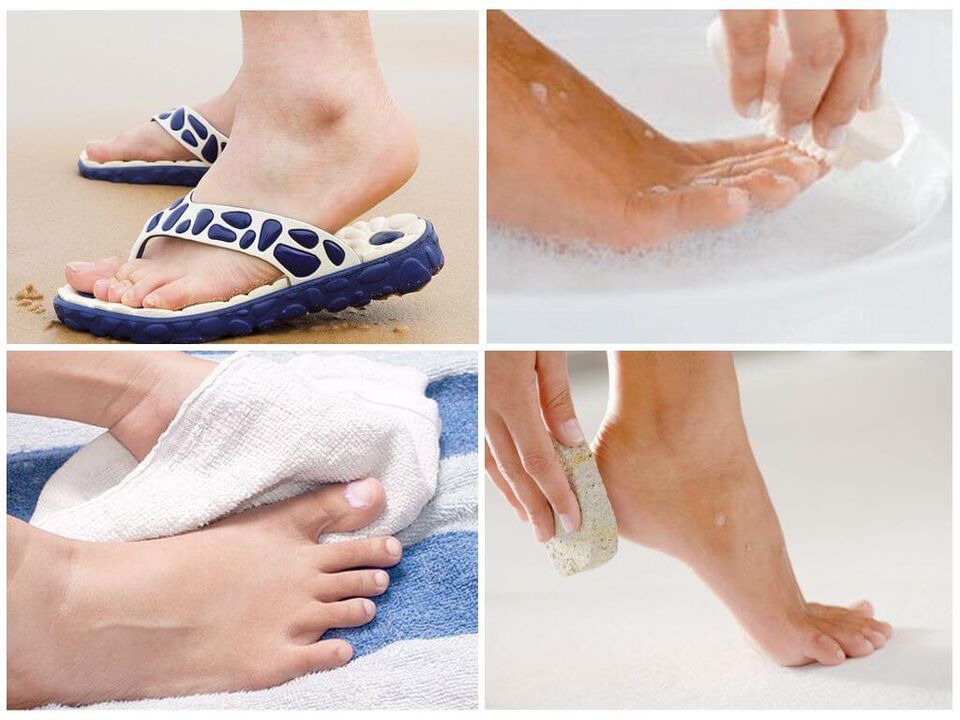 Prevention of onychomycosis includes foot hygiene, use of personal items and timely pedicure