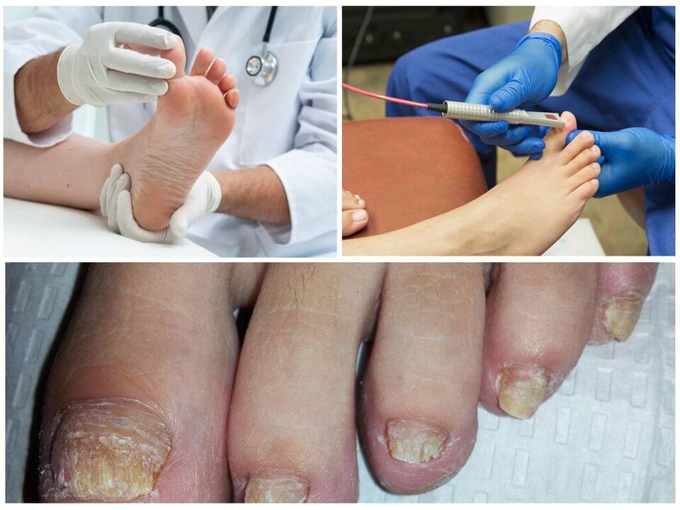 The doctor diagnoses and treats toenails affected by a fungal infection. 